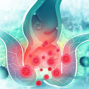 Anal Fistül Belirtileri