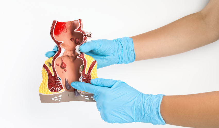 ANAL FİSTÜL - Fistül Tedavisi Anal Fistül