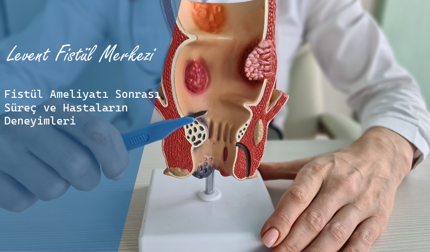 Fistül Ameliyatı Sonrası Süreç ve Hastaların Yorumları