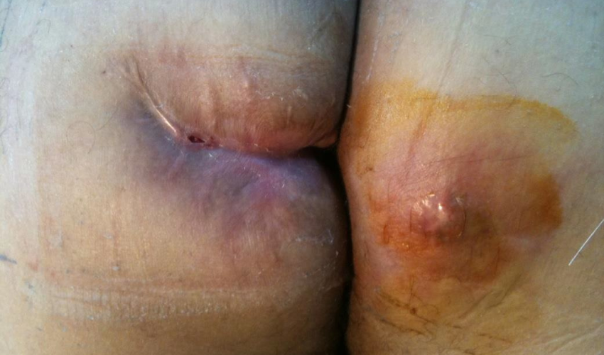 fistül görüntüsü - Fistül Tedavisi fistül görüntüsü