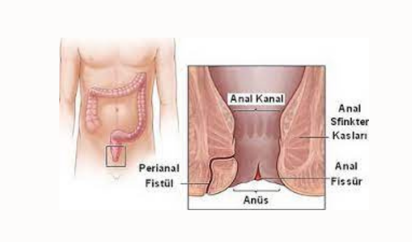 Fissür ve Fistül Arasındaki Fark Nedir?