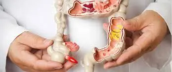 Perianal fistül lazer tedavisi nedir?